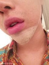 组图：日男整形肿成猪头 整完被调侃“真蛇精”