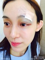 组图：范玮琪摔伤眉头缝20针老公 黑人贴心照顾