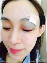 组图：范玮琪摔伤眉头缝20针老公 黑人贴心照顾