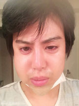 组图：日男整形肿成猪头 整完被调侃“真蛇精”